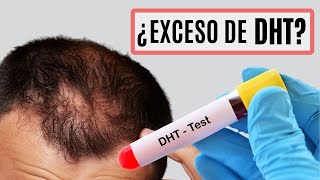 ALOPECIA causada por DHT 👉 Dihidrotestosterona y la CALVICIE [upl. by Atenek259]