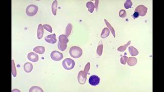 Schistoctyte Helmet Cells Sickle Cell amp Spherocyte [upl. by Veno834]