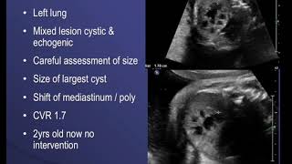 TMT Echogenic Lungs  Dr Alpana Joshi  CCAM  Pulmonary Sequestration  CPAM  Fetal Medicine [upl. by Geirk100]