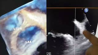 Left Atrial Appendage  LAA  amp Left Upper Pulmonary Vein  LUPV   with Cumadine ridge [upl. by Coney]