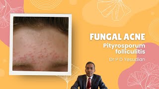 Pityrosporum or Malassezia folliculitis fungal acne [upl. by Bachman]