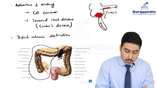 Acute Appendicitis  Causes pathophysiology and clinical features [upl. by Luht1]