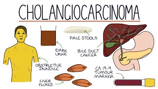 Understanding Cholangiocarcinoma [upl. by Linad339]