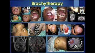 Role of brachytherapy in the treatment of cancer कैंसर के उपचार में ब्रैकीथेरेपी की भूमिका [upl. by Alita]