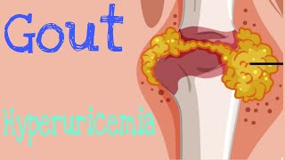 Gout  Hyperuricemia  Causes and Treatment  Lecture 7 [upl. by Ellasal335]