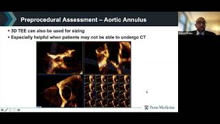 Joint Echo Conference Structural Heart AV Intervention [upl. by Eikin]