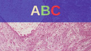 Aneurysmal Bone Cyst  Pathology mini tutorial [upl. by Antons]