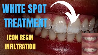 White Spots Fluorosis Smile Transformation  Before and After Procedure with ICON Resin Infiltration [upl. by Cohin730]