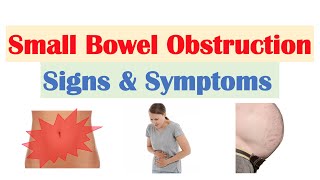 Small Bowel Obstruction SBO Signs amp Symptoms amp Why They Occur [upl. by Tonkin600]