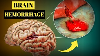 Brain Hemorrhage Causes Symptoms Treatment and Prevention [upl. by Derte]