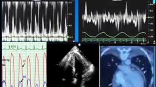 Constrictive pericarditis diagnosis echocardiography and treatment [upl. by Remus]