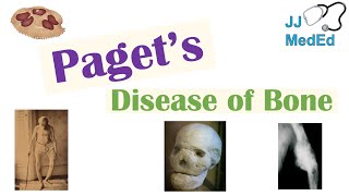 Paget’s Disease of Bone Osteitis Deformans  Causes Pathogenesis Symptoms Diagnosis amp Treatment [upl. by Attelahs]