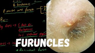 FURUNCLE  Localized Acute Otitis Externa [upl. by Nortad]