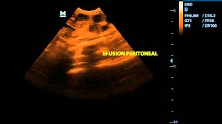 Neoplasia esplenica Efusion peritoneal [upl. by Imoyik]