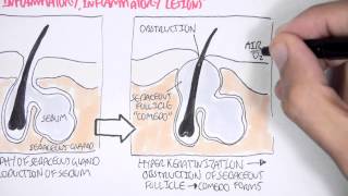 Acne Pathophsyiology [upl. by Yesnek582]