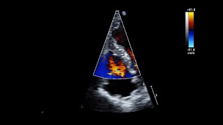 Ventricular Septal Rupture After Acute Myocardial Infarction [upl. by Everett692]