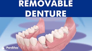 Removable partial denture © [upl. by Nailuj542]