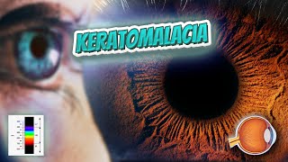 Keratomalacia Your EYEBALLS 👁️👁️💉😳💊🔊💯✅ [upl. by Eenert142]