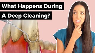 What Happens During a Deep Cleaning Procedure Scaling and Root Planing [upl. by Yemorej]