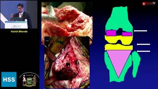 Evolution amp Heritage of Metaphyseal Sleeves amp Implant Compatibility  Dr Harish Bhende [upl. by Haggerty]