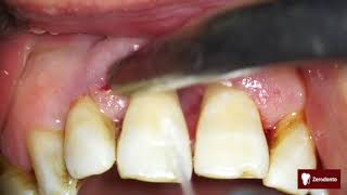 Advanced periodontal disease [upl. by Anirbes]