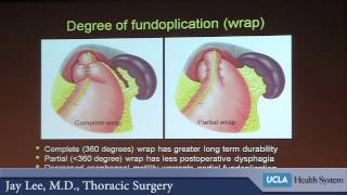 Surgery and the Esophagus  What does minimally invasive mean  Dr Jay Moon Le [upl. by Lenoj]