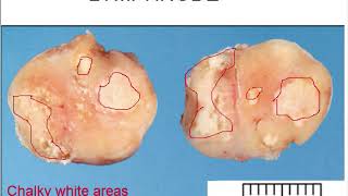 Chronic Lymphadenitis gross and microscopic features for medical students [upl. by Dewhurst]