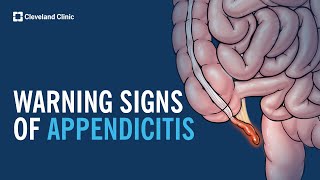 Warning Signs of Appendicitis [upl. by Hareehat]