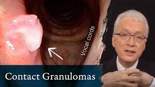 Contact Granulomas or Contact Ulcers [upl. by Ern93]