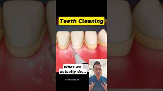 Dental Cleaning What You Need to Know dentallan dentist shorts [upl. by Ettelegna]