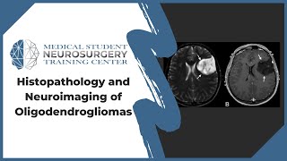 Histopathology and Neuroimaging of Oligodendrogliomas [upl. by Hsot]