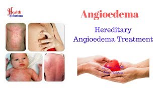 Angioedema  Hereditary Angioedema Treatment Made Simple [upl. by Delgado]