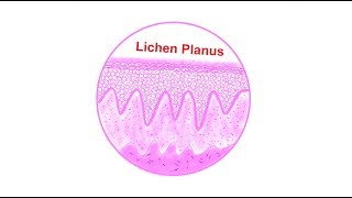 Lichen planus Histopathological features  Lets draw [upl. by Adlay]