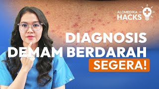 Tes Rumpel Leede Tourniquet Test untuk Demam Berdarah Dengue [upl. by Ylle]