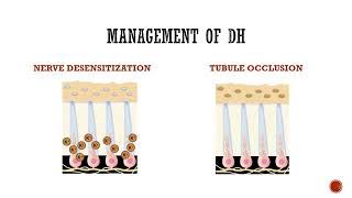 Dentinal Hypersensitivity [upl. by Llemor]