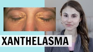 XANTHELASMA WHAT IT IS amp HOW IT IS TREATED DR DRAY [upl. by Millda939]