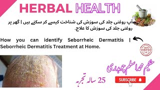 How you can identify Seborrheic Dermatitis  Seborrheic Dermatitis Treatment at Home [upl. by Jessie]