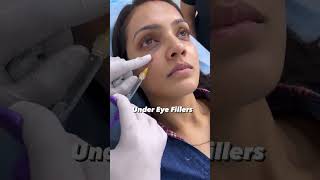 under eye filler treatment helps you get rid of wrinkles  Dermalyn Aesthetics  Dr Muskan Tyagi [upl. by Harrison]