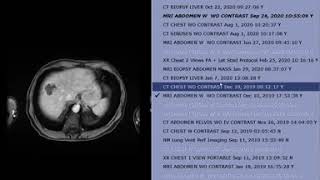 Abdominal case conference  11242020 [upl. by Labinnah]