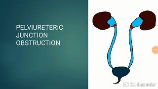 PUJO Pelviureteric junction obstruction Pediatric Surgery [upl. by Norvun]