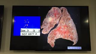 Introduction to Lung Pathology [upl. by Kcirdnek]