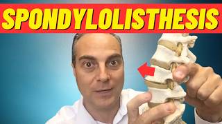 What Is Spondylolisthesis What Is Anterolisthesis Dr Walter Salubro Chiropractor in Vaughan [upl. by Royden]