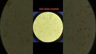 Uric Acid crystals GUE URINEEXAMINATION crystals urinalysis urineanalysis [upl. by Jay588]