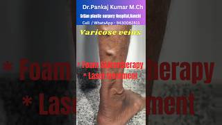 Varicose veins treatment for SSC GD medical Best varicose veins treatment shorts varicoseveins [upl. by Manella663]