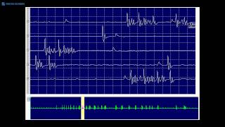 Kimura amp Kohara F34 Typical myokymic discharge seen in a demyelinating neuropathy [upl. by Enirrok]