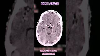 NCCT Brain l mild fever with convulsion shorts ctscan [upl. by Akcire]