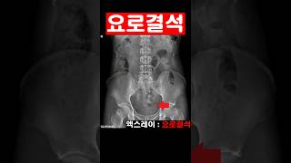 요로결석 체외충격파쇄석술 결석 요관 ureter stone ESWL Extracorporeal Shock Wave lithotripsy stone ureter [upl. by Atin]