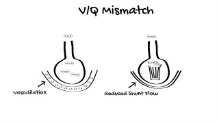 Inhaled Nitric Oxide in ICU [upl. by Cordle112]