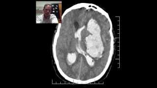 CT Head HTN Hemorrhage w Herniation DISCUSSION by Radiologist [upl. by Willem]