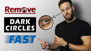 BEST ways to get rid of DARK CIRCLES under your EYES  THE TRUTH [upl. by Dnalhsa76]